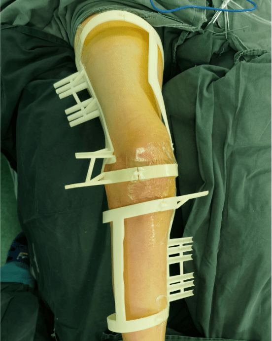 春立医疗获得发明专利授权：“一种仿生型假体截骨定位导板”